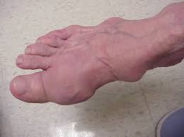 gout_foot_symptoms