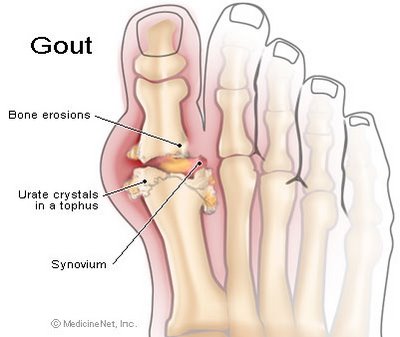gout_symptoms